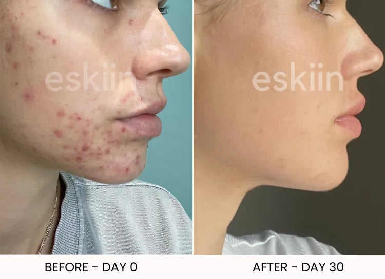 Side-by-side comparison of a face with acne before and clear skin after 30 days.